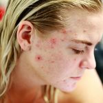 5 Adult acne causes and their cure