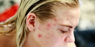 5 Adult acne causes and their cure
